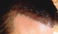 FUE Hairline Clinic image 1